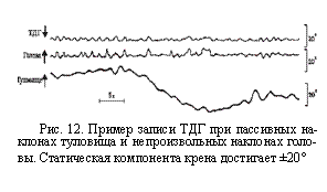 Подпись:  
Рис. 12. Пример записи ТДГ при пассивных на¬клонах туловища и непроизвольных наклонах голо¬вы. Статическая компонента крена достигает ±20°
